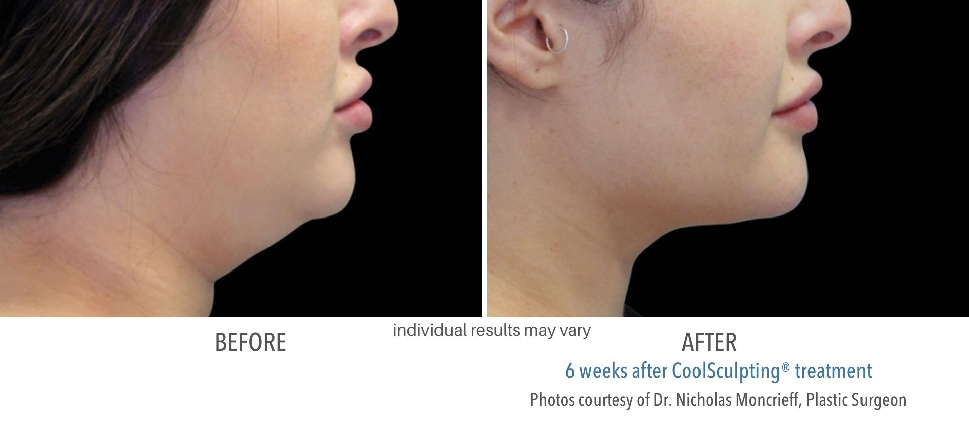 CoolSculpting double chin treatment in Westlake, OH