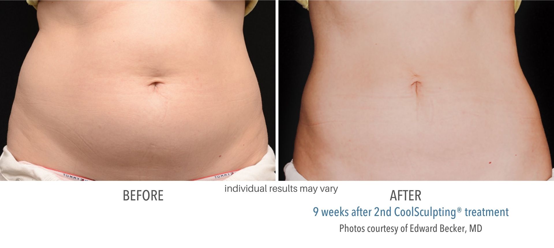 CoolSculpting abdomen treatment in Westlake, OH