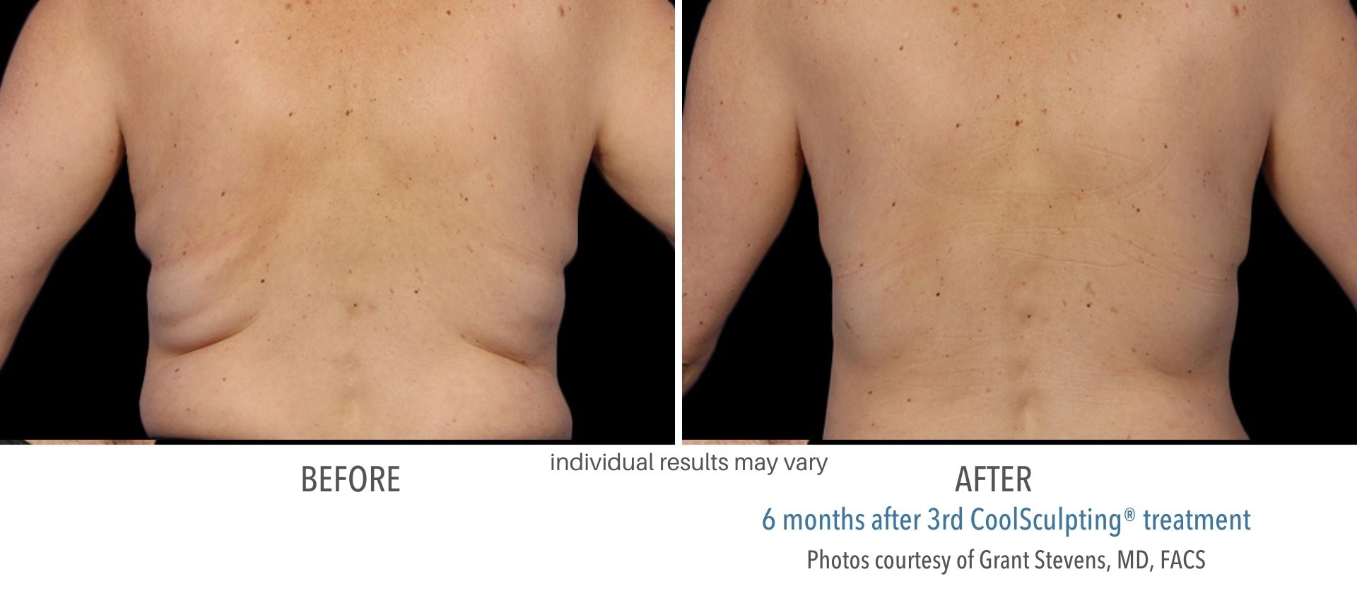 CoolSculpting Back fat treatment in Westlake, OH
