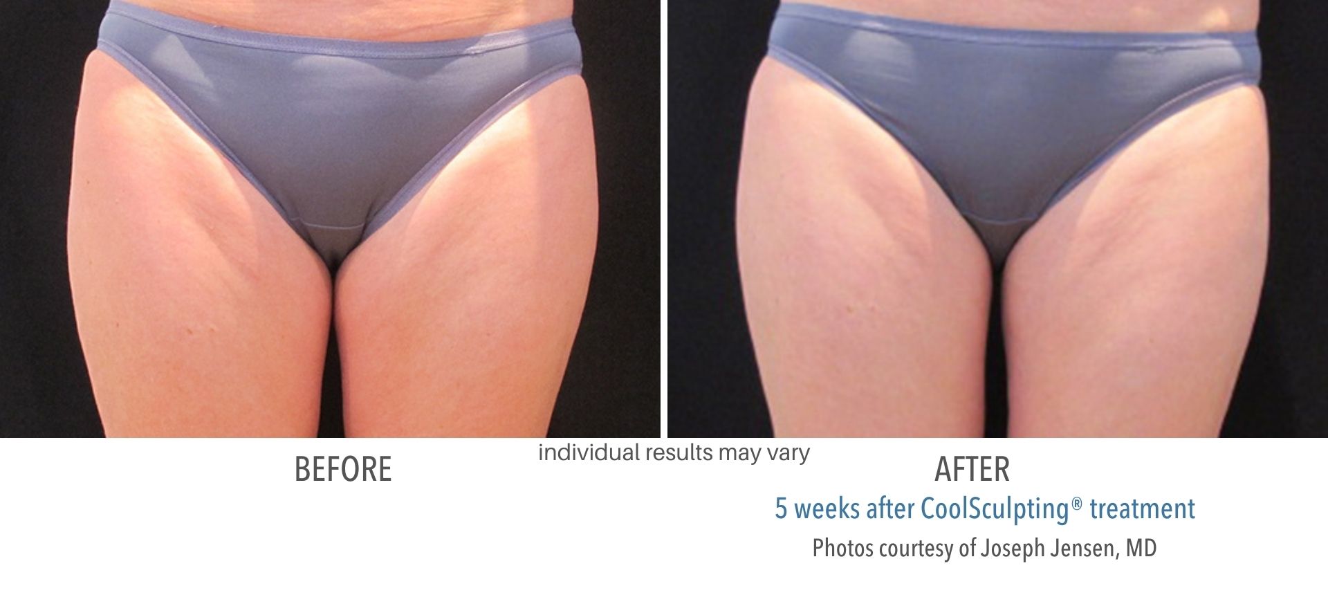 CoolSculpting thighs treatment in Westlake, OH