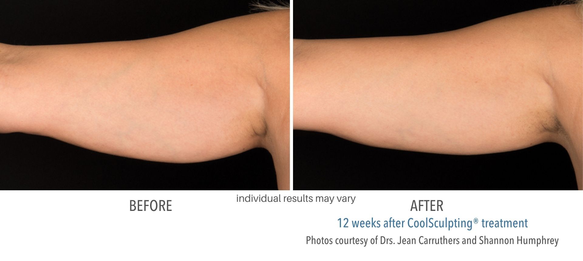 CoolSculpting arms treatment in Westlake, OH