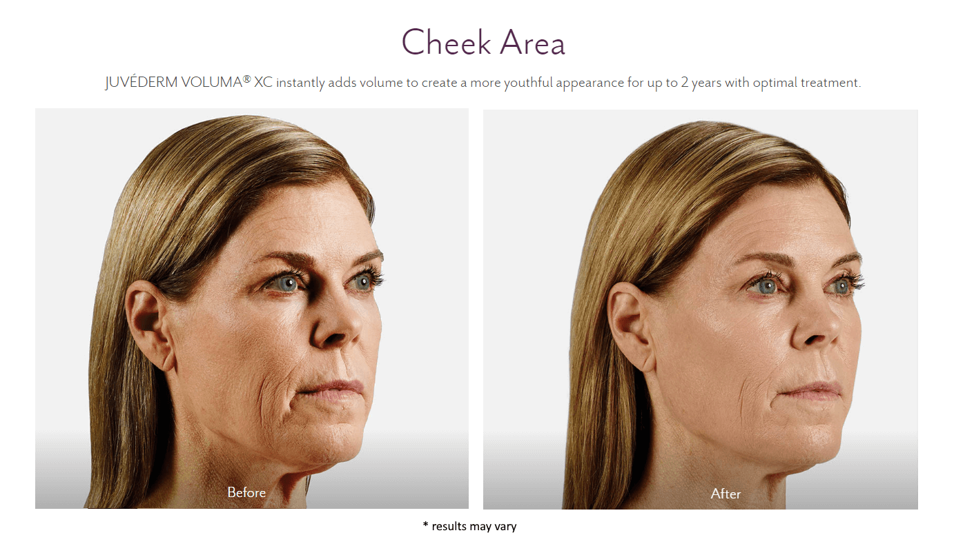 juvederm_before_and_after_10