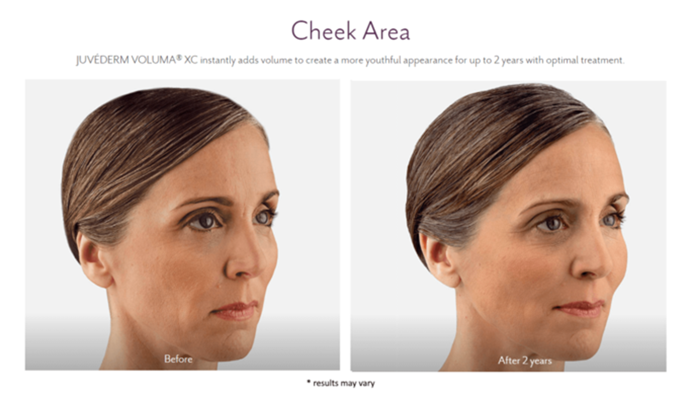 juvederm_before_and_after_12