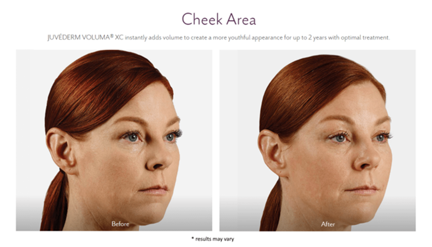 juvederm_before_and_after_13