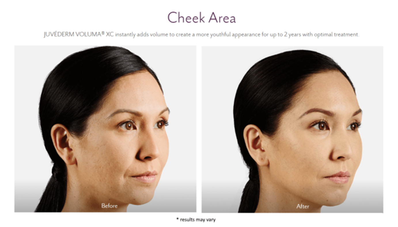 juvederm_before_and_after_14